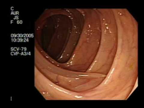 أسباب وعلاج الديدان عند الأطفال